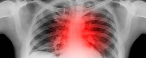 MYTH: Stress Tests and Cholesterol Screenings determine Heart Disease Risks